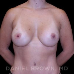 Breast Augmentation Before & After Patient #9089