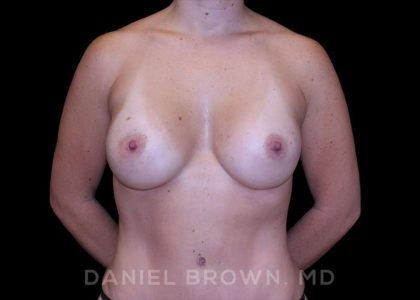 Breast Augmentation Before & After Patient #9089