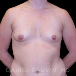 Breast Augmentation Before & After Patient #9089