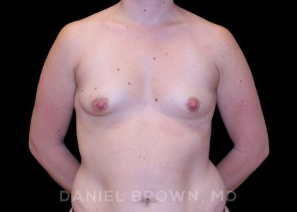 Breast Augmentation Before & After Patient #9089