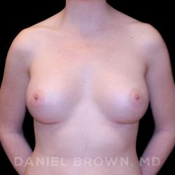 Breast Augmentation Before & After Patient #9100