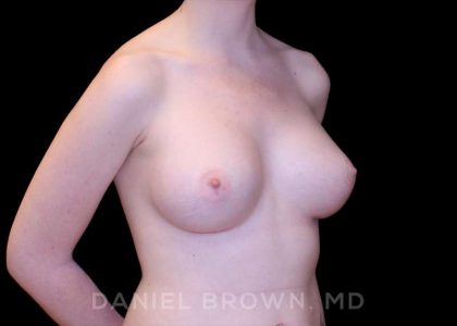 Breast Augmentation Before & After Patient #9100