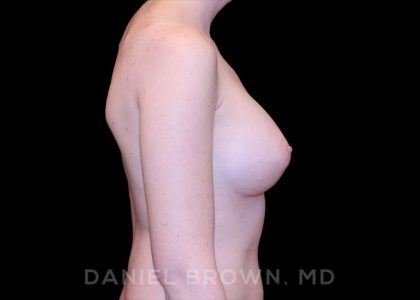 Breast Augmentation Before & After Patient #9100