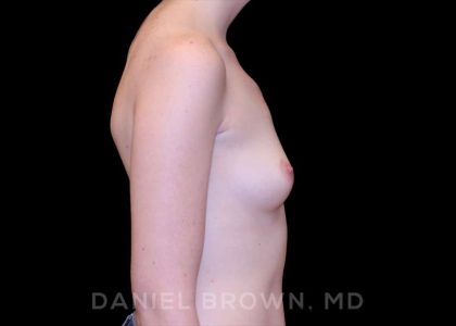 Breast Augmentation Before & After Patient #9100