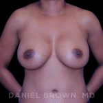 Breast Augmentation Before & After Patient #9107