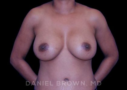 Breast Augmentation Before & After Patient #9107