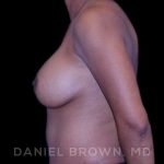 Breast Augmentation Before & After Patient #9107