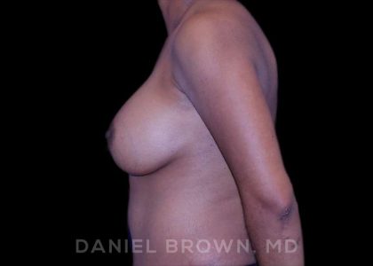 Breast Augmentation Before & After Patient #9107