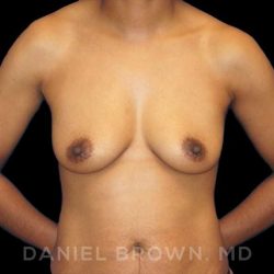 Breast Augmentation Before & After Patient #9107
