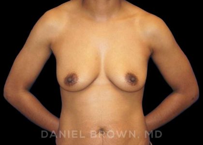 Breast Augmentation Before & After Patient #9107