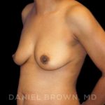 Breast Augmentation Before & After Patient #9107