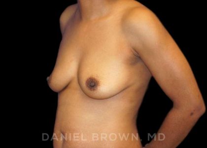 Breast Augmentation Before & After Patient #9107