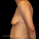 Breast Augmentation Before & After Patient #9107