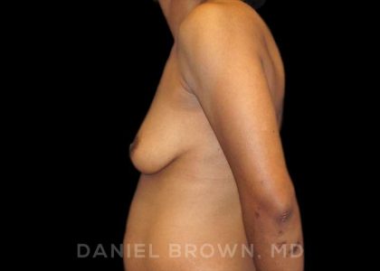 Breast Augmentation Before & After Patient #9107