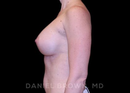 Breast Augmentation Before & After Patient #9118