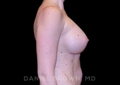 Breast Augmentation Before & After Patient #9118