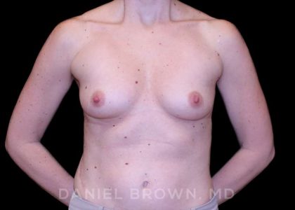 Breast Augmentation Before & After Patient #9118