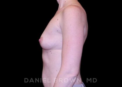 Breast Augmentation Before & After Patient #9118