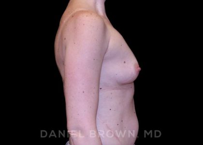 Breast Augmentation Before & After Patient #9118