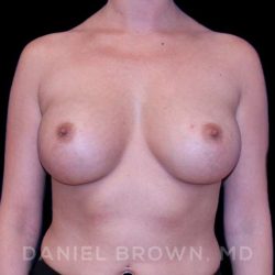 Breast Augmentation Before & After Patient #9125
