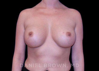 Breast Augmentation Before & After Patient #9125