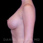 Breast Augmentation Before & After Patient #9125