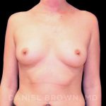 Breast Augmentation Before & After Patient #9125