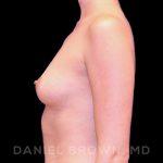 Breast Augmentation Before & After Patient #9125