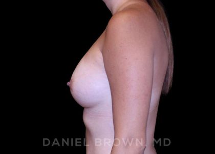 Breast Augmentation Before & After Patient #9136