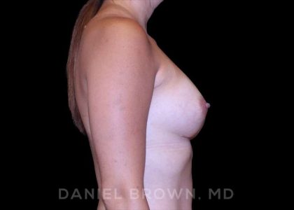 Breast Augmentation Before & After Patient #9136