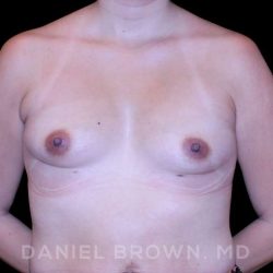 Breast Augmentation Before & After Patient #9136