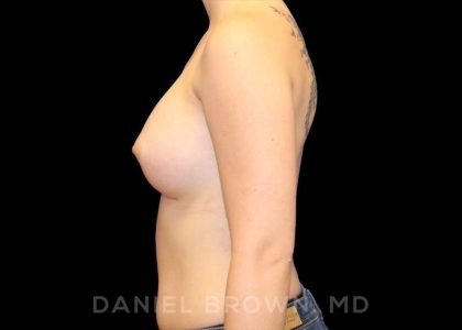 Breast Augmentation Before & After Patient #9143