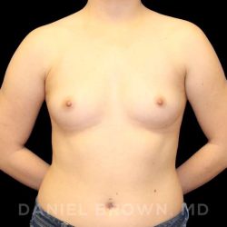 Breast Augmentation Before & After Patient #9143