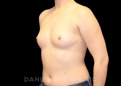 Breast Augmentation Before & After Patient #9143