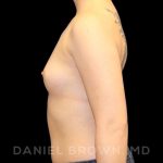 Breast Augmentation Before & After Patient #9143
