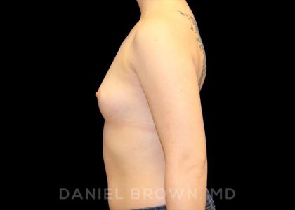 Breast Augmentation Before & After Patient #9143