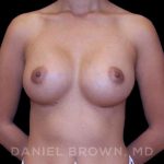 Breast Augmentation Before & After Patient #9154