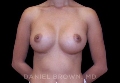 Breast Augmentation Before & After Patient #9154