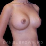 Breast Augmentation Before & After Patient #9154