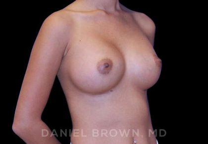 Breast Augmentation Before & After Patient #9154