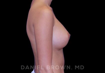 Breast Augmentation Before & After Patient #9154