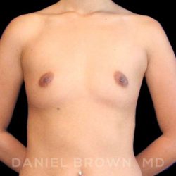 Breast Augmentation Before & After Patient #9154