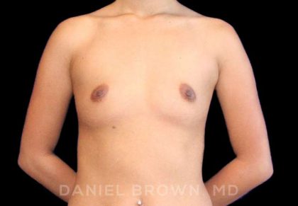 Breast Augmentation Before & After Patient #9154