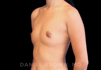 Breast Augmentation Before & After Patient #9154