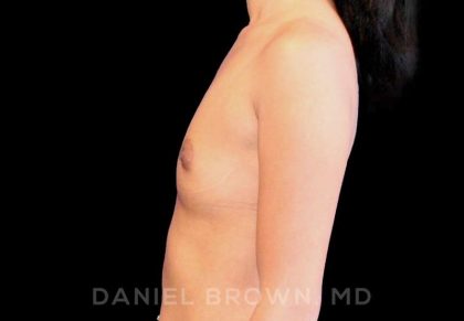 Breast Augmentation Before & After Patient #9154