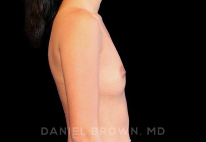 Breast Augmentation Before & After Patient #9154