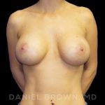 Breast Augmentation Before & After Patient #9161