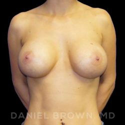 Breast Augmentation Before & After Patient #9161