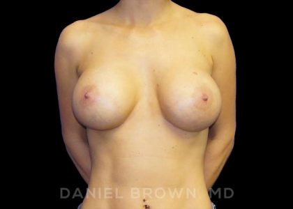 Breast Augmentation Before & After Patient #9161