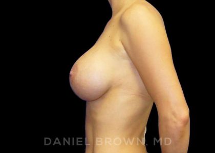 Breast Augmentation Before & After Patient #9161
